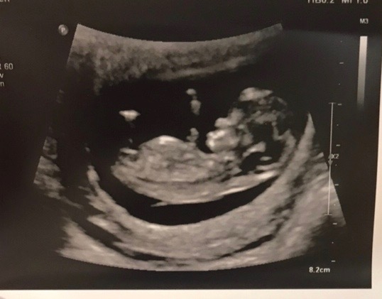 Baby Robinson at Eleven Weeks